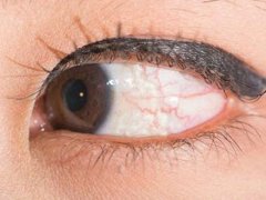 先天性视网膜色素变性怎么治疗